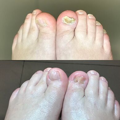 Expérience dans l'utilisation de Barnabas à la crème prometteuse d'Israël, photo avant et après