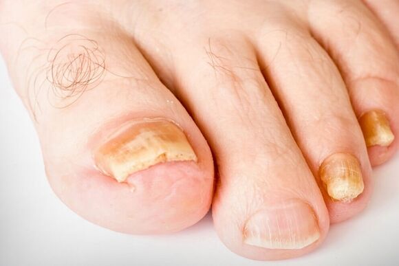 La troisième étape du hirb de l'ongle
