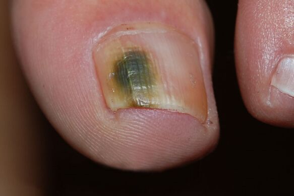 Type de champignon à ongles moisie