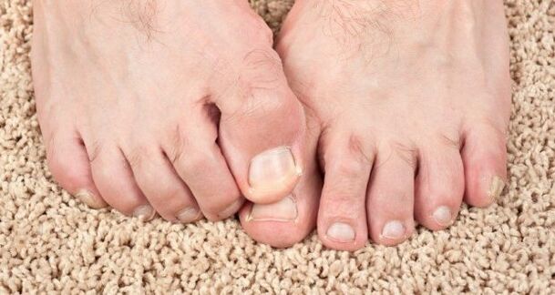 Symptômes des champignons de l'ongle