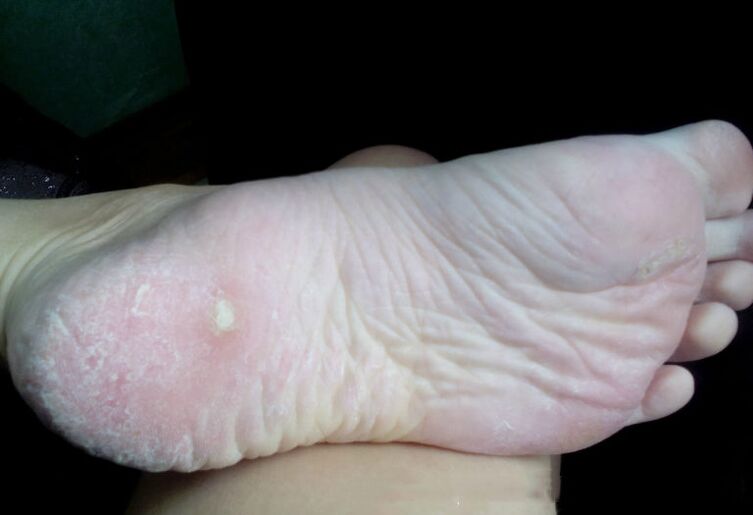 Traitement du champignon avec un laser