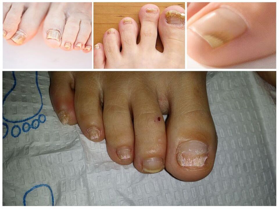 Maladies fongiques des plaques à ongles