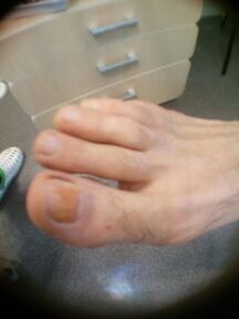 stade initial de la mycose des ongles du gros orteil