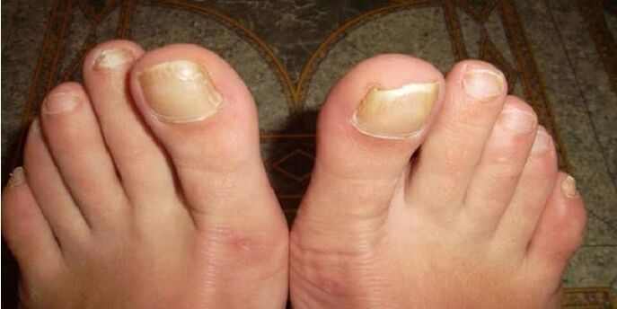 à quoi ressemble la mycose des ongles des pieds