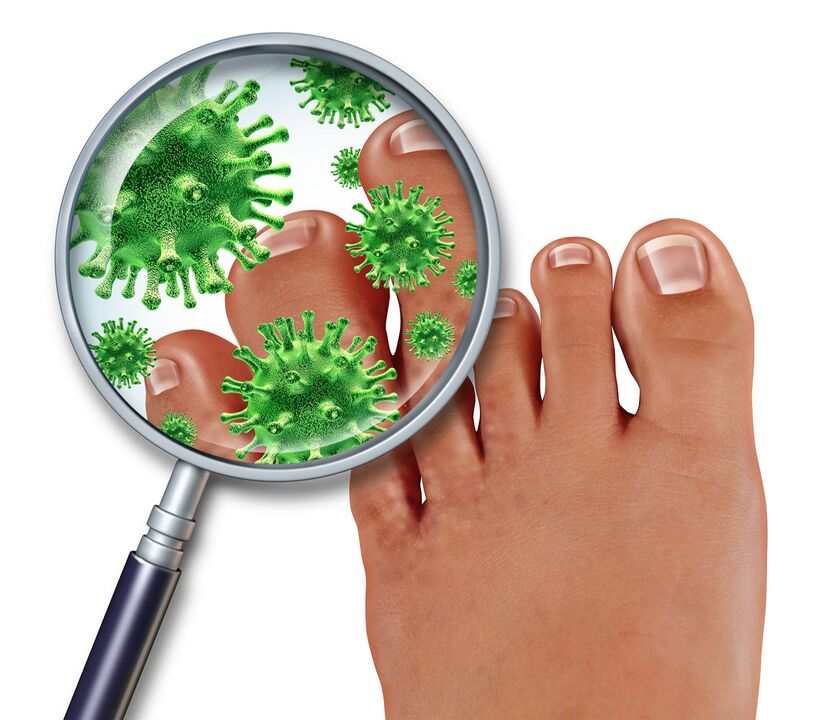 champignon des ongles