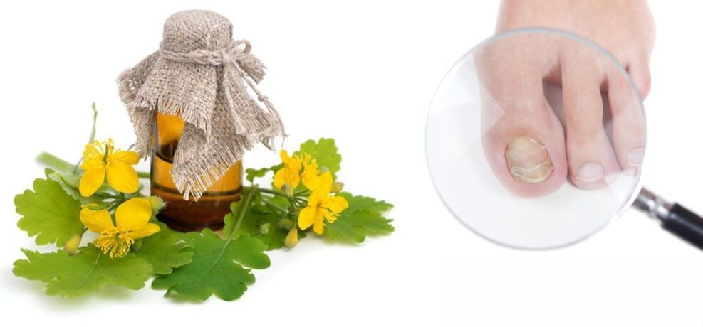 Chélidoine pour mycose des ongles