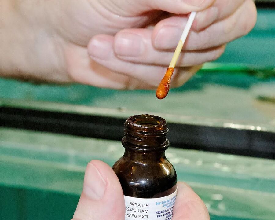 L'application d'un mélange d'iode et de jus de chélidoine sur les ongles des pieds éliminera les champignons